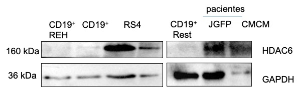 La proteína HDAC6 está sobreexpresada en líneas celulares y células de pacientes de  LLA-B comparada con células CD19+ de individuos sanos.